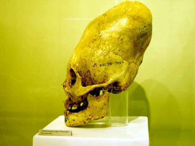 Altered skull